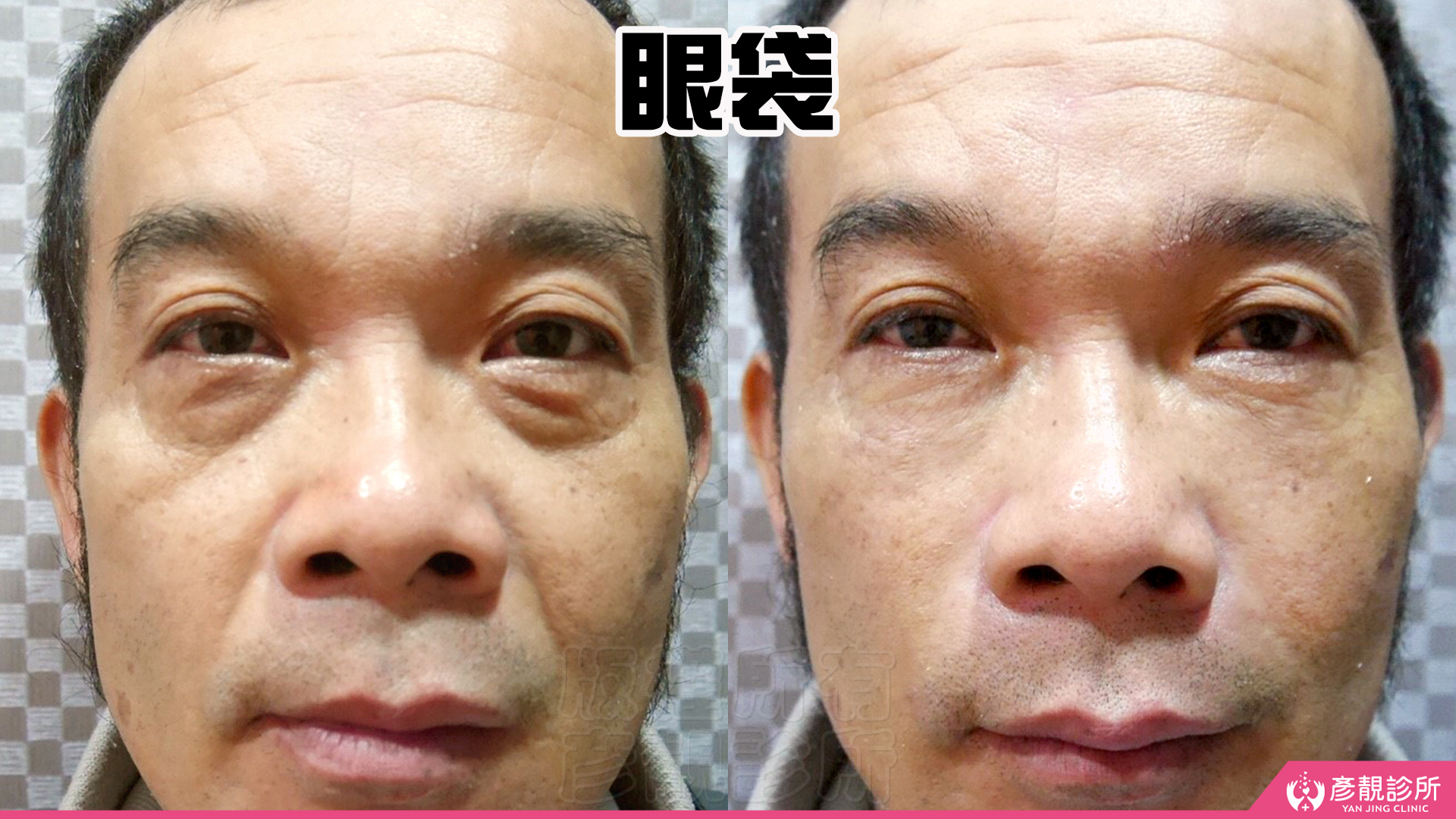 淚溝怎麼改善?先辨黑眼圈成因,再選適合的療程 14 男性眼袋型淚溝改善的正面前後對照,左圖眼袋隆起及其下緣凹陷形成較深陰影,右圖眼袋下方與臉頰的交界較平順,原本明顯的凸凹轉折變柔和,呈現同時評估眼袋與淚溝、改善眼下疲倦外觀的規劃方向。