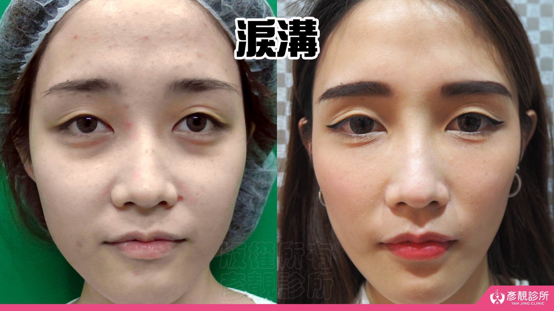 淚溝跟眼袋到底怎麼分？治療方式比較分析，如何避免淚溝填補眼袋改善的副作用- 彥靚診所× 醫美．減重