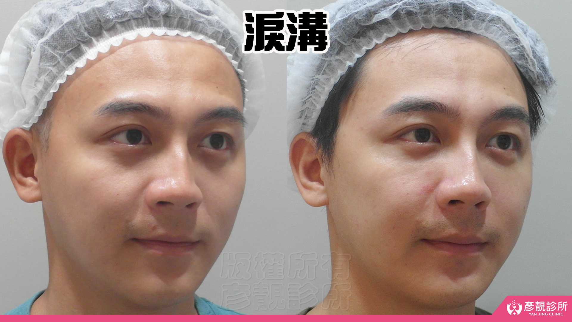 單純型淚溝填充:改善看哪裡?什麼時候需要再補? 6 男性單純型淚溝術前術後,左圖眼頭下方的凹溝向外延伸,右圖凹陷落差減少、眼下輪廓較平順,靠近下眼瞼仍留有較深色澤,對照呈現淚溝深度改善與皮膚顏色是回診時分開判斷的兩件事。