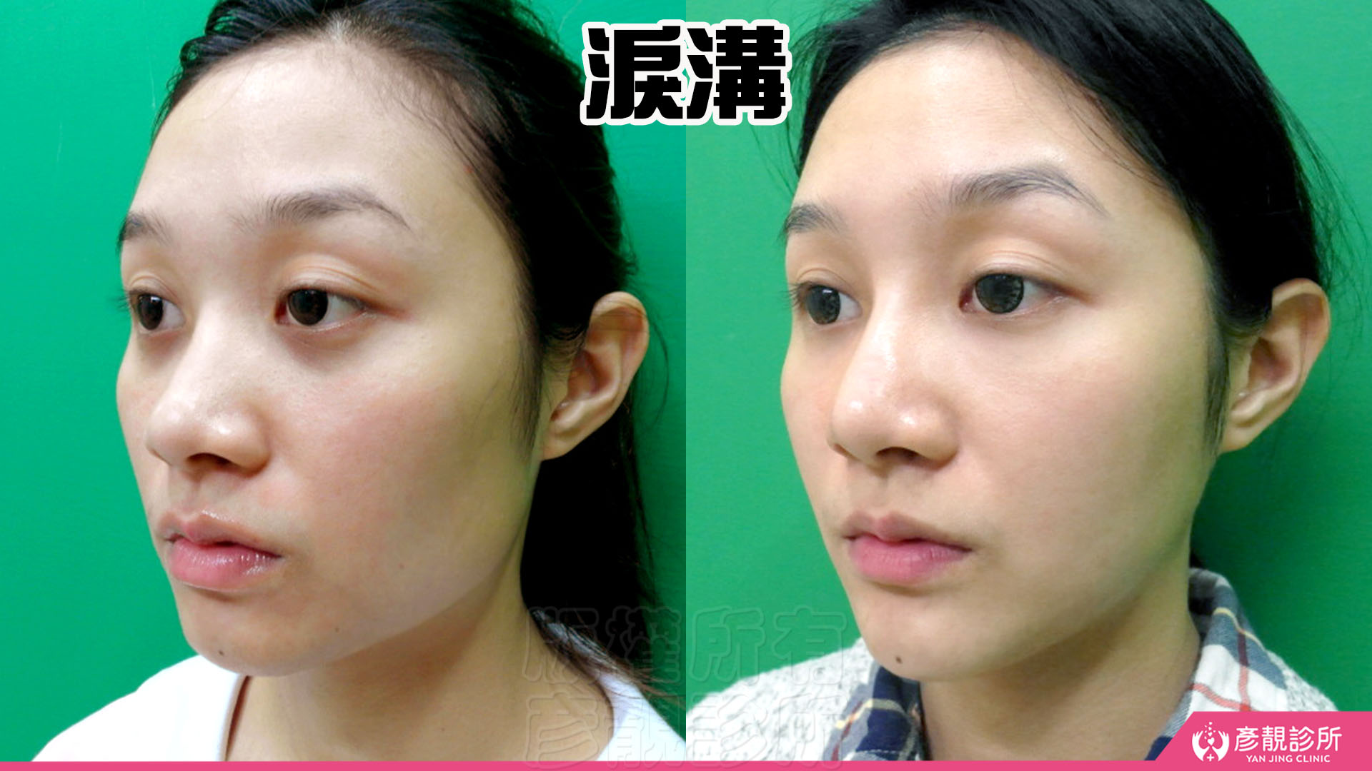淚溝怎麼改善?先辨黑眼圈成因,再選適合的療程 1 女性淚溝改善的斜側面前後對照,左圖內眼角向外延伸的凹溝與陰影較清楚,右圖眼下線條較平順,淚溝暗影減輕並保留臥蠶下的自然分界,呈現依凹陷位置規劃填補、維持眼周立體感的改善方向。