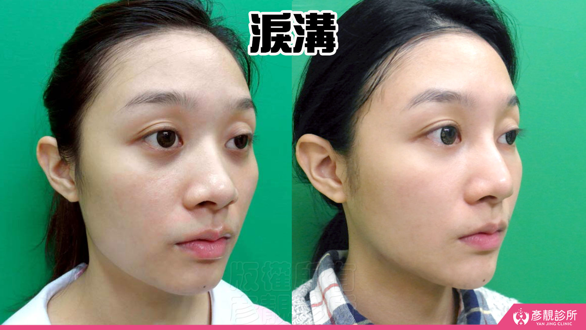 單純型淚溝填充:改善看哪裡?什麼時候需要再補? 1 單純型淚溝女性術前術後,左圖眼頭向外延伸的凹陷在臥蠶下方形成深色暗帶,右圖淚溝變淺、眼下與臉頰銜接較平順,原本深陷的疲倦感減輕,呈現改善凹陷陰影後眼神較明亮的外觀。
