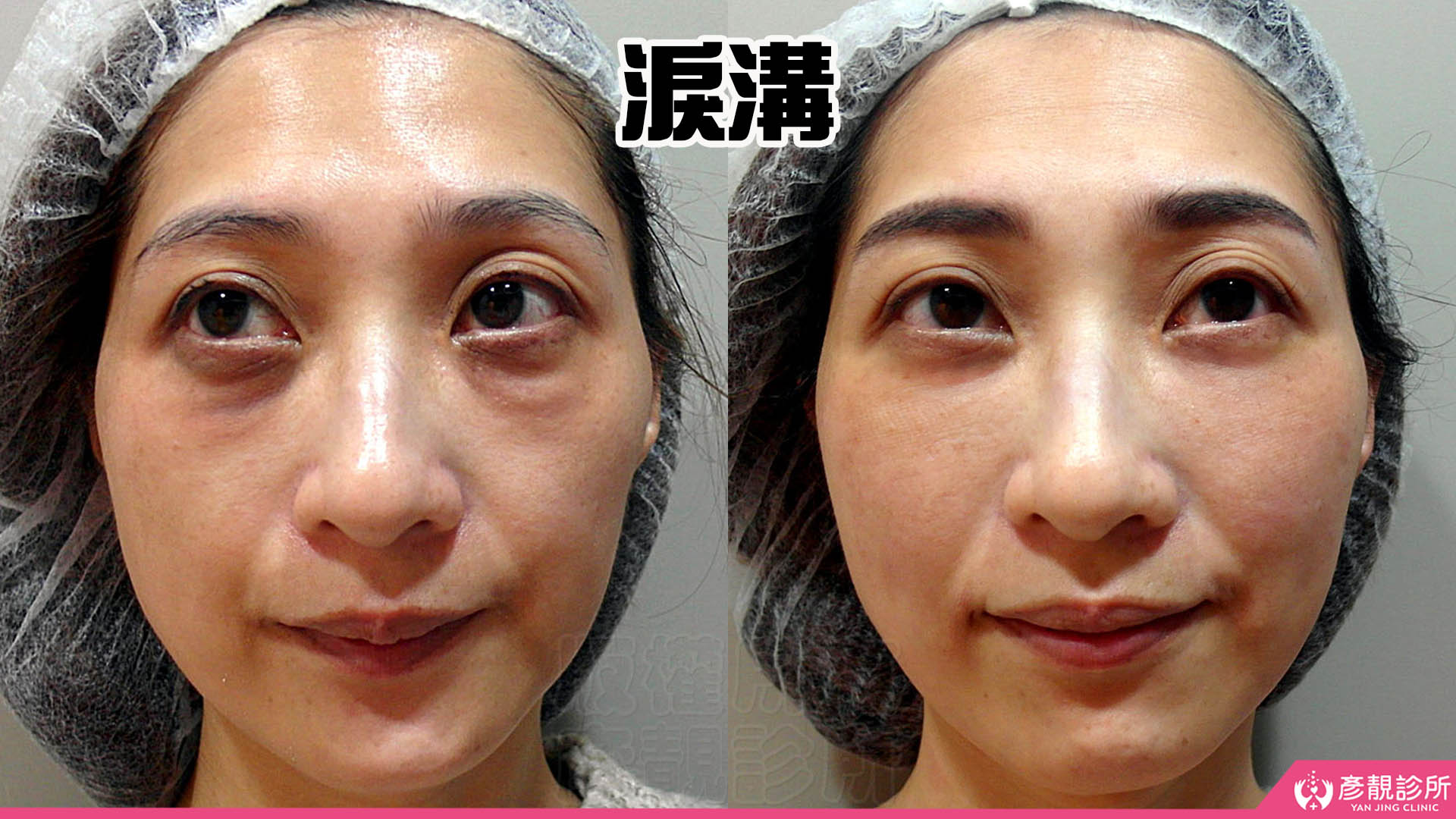 淚溝怎麼改善?先辨黑眼圈成因,再選適合的療程 7 第二步眼周部位辨識的女性對照圖,左圖可見眼袋與下方淚溝陰影,右圖眼下較平順、臥蠶仍可辨識,搭配筆者的支撐觀點,說明改善凸凹落差時,也要保留貼近睫毛的自然隆起與層次。