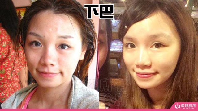 Jawline Enhancement Chin Augmentation Cost10031 1024x576