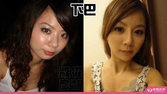 Jawline Enhancement Chin Augmentation Cost100312 1024x576