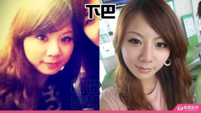Jawline Enhancement Chin Augmentation Cost100313 1024x576