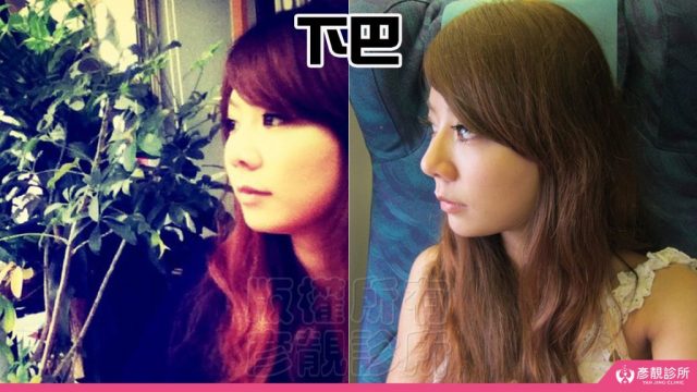 Jawline Enhancement Chin Augmentation Cost100314 1024x576