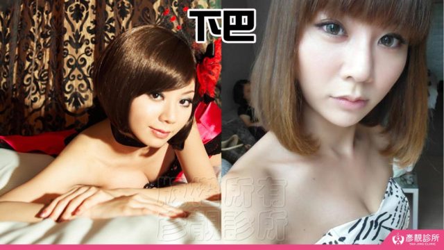 Jawline Enhancement Chin Augmentation Cost100315 1024x576