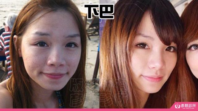 Jawline Enhancement Chin Augmentation Cost10032 1024x576