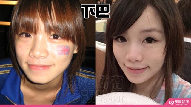 Jawline Enhancement Chin Augmentation Cost10033 1024x576