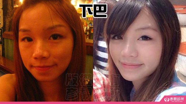 Jawline Enhancement Chin Augmentation Cost10034 1024x576