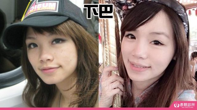 Jawline Enhancement Chin Augmentation Cost10035 1024x576