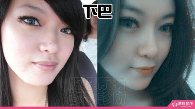 Jawline Enhancement Chin Augmentation Cost10036 1024x576