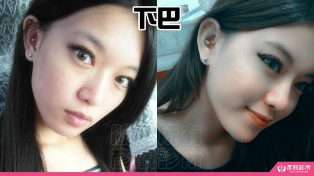 Jawline Enhancement Chin Augmentation Cost10037 1024x576
