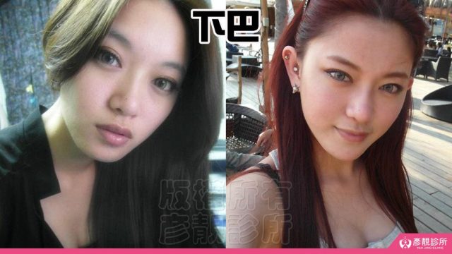 Jawline Enhancement Chin Augmentation Cost10038 1024x576