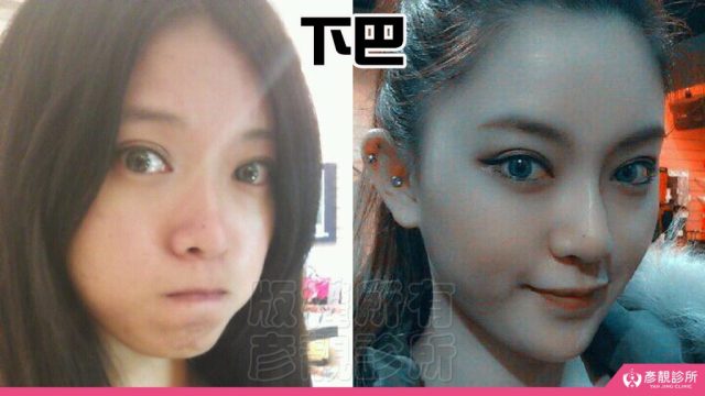Jawline Enhancement Chin Augmentation Cost10039 1024x576