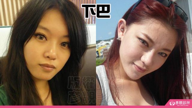 Jawline Enhancement Chin Augmentation Cost10071 1024x576