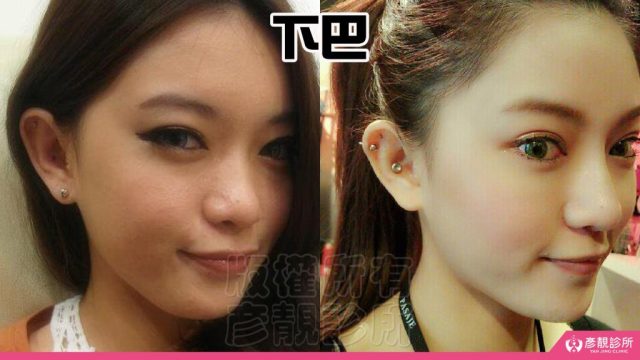Jawline Enhancement Chin Augmentation Cost10072 1024x576