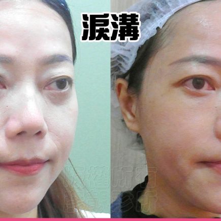 單純型淚溝填充:改善看哪裡?什麼時候需要再補? 1 淚溝、眼袋與結構型黑眼圈術前術後;術前重點為淚溝陰影與結構型黑眼圈暗度,療程後眼袋邊界不再顯得突兀,淚溝線條較柔順,眼下更平順且保留自然表情。4D 無痕筋膜提升以眼下與中臉支撐方向,連動淚溝、眼袋和蘋果肌上緣。