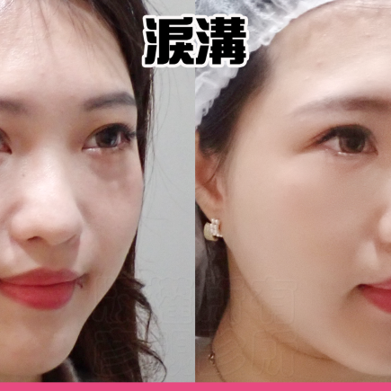 溝渠型淚溝怎麼改善?小眼袋與深凹線,要一起處理才平順 1 淚溝、眼袋與結構型黑眼圈術前術後;術前重點為眼袋下緣與淚溝凹陷的高低差,療程後淚溝凹陷變淺,結構型黑眼圈視覺暗度較淡,眼下更平順且保留自然表情。位置、用量與動靜態比例正確,可避免饅化。