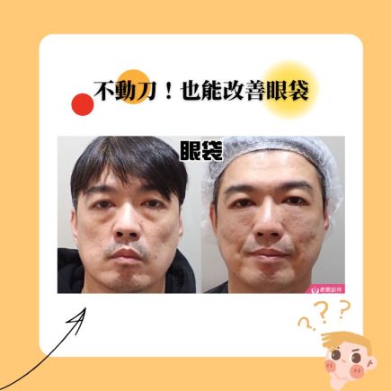改善眼袋不用動刀,玻尿酸改善眼袋的關鍵,詳解玻尿酸優勢與手術差異 6 不動刀也能消除眼袋
