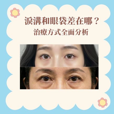 淚溝和眼袋形成原因,改善淚溝和眼袋的治療方式有哪些? 16 Sobeauty淚溝和眼袋