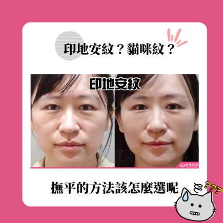 印地安紋是什麼?印地安紋形成原因有哪些?改善印地安紋應該選哪種療程 4 印地安紋 貓咪紋 精選