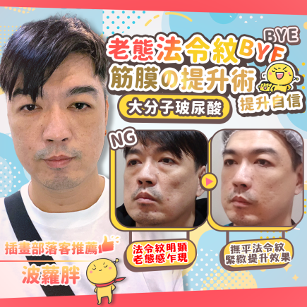 彥靚診所法令紋填補心得|法令紋很深怎麼辦?玻尿酸改善凹陷老態,選對大分子材質很重要!不位移、不饅化的填補秘密 47 無痕筋膜提升 幼態臉 埋線 法令紋 笑紋 淚溝 拉提 玻尿酸 彥靚 診所 醫生 推薦 台北 桃園 新竹 鼻基底凹陷 評價115011301