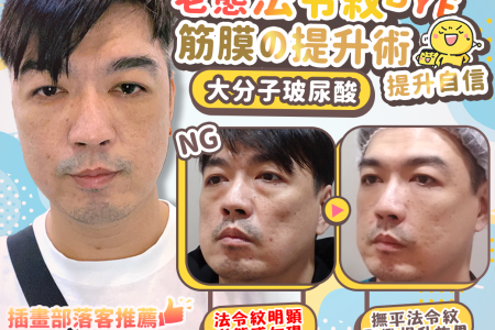 無痕筋膜提升 幼態臉 埋線 法令紋 笑紋 淚溝 拉提 玻尿酸 彥靚 診所 醫生 推薦 台北 桃園 新竹 鼻基底凹陷 評價115011301