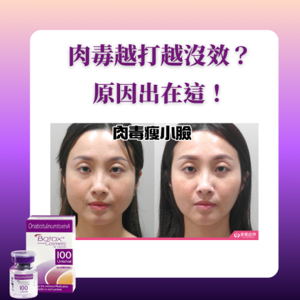 為什麼肉毒越打越沒效?醫師揭秘肉毒抗藥性:這 3 個壞習慣是主因 2 肉毒抗藥性精選