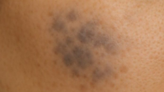 顴骨母斑灰藍色