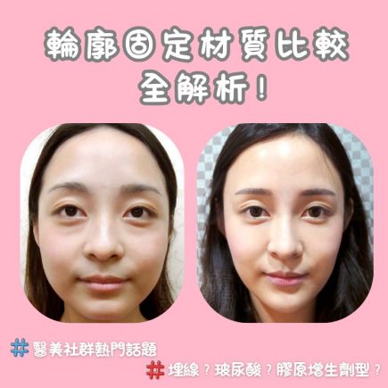輪廓固定材質怎麼選？ 1