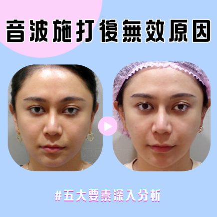 打完音波沒有拉提感？