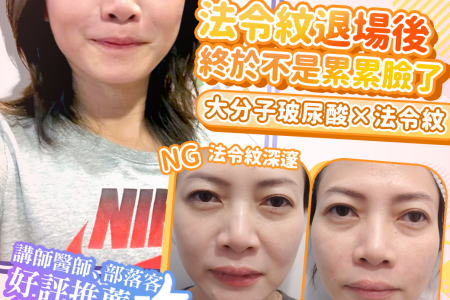 無痕筋膜提升 幼態臉 埋線 法令紋 笑紋 淚溝 拉提 玻尿酸 彥靚 診所 醫生 推薦 台北 桃園 新竹 鼻基底凹陷 評價115040601 1