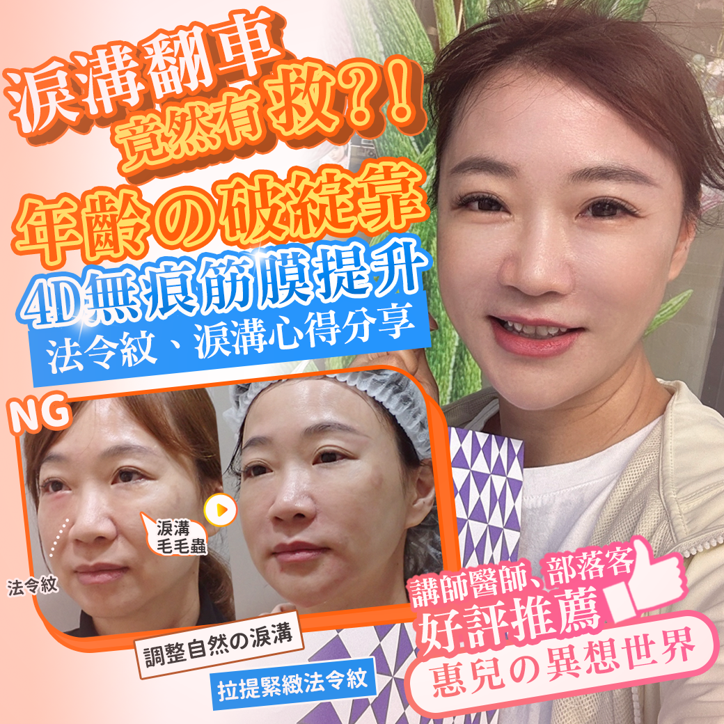 法令紋真的藏不住年紀?淚溝失敗竟然有得救?告別無盡的修圖深淵|神奇的 4D無痕筋膜提升 1 彥靚診所 4D無痕筋膜提升 黃政達醫師 拉提 緊緻 淚溝重修 眼袋 法令紋 玻尿酸 填補 幼態臉 複合式微整 鬆弛 下垂 嘴邊肉 雙下巴 輪廓線 下顎線 淚溝硬塊 分享 推薦 桃園 台北 新竹 1150060101