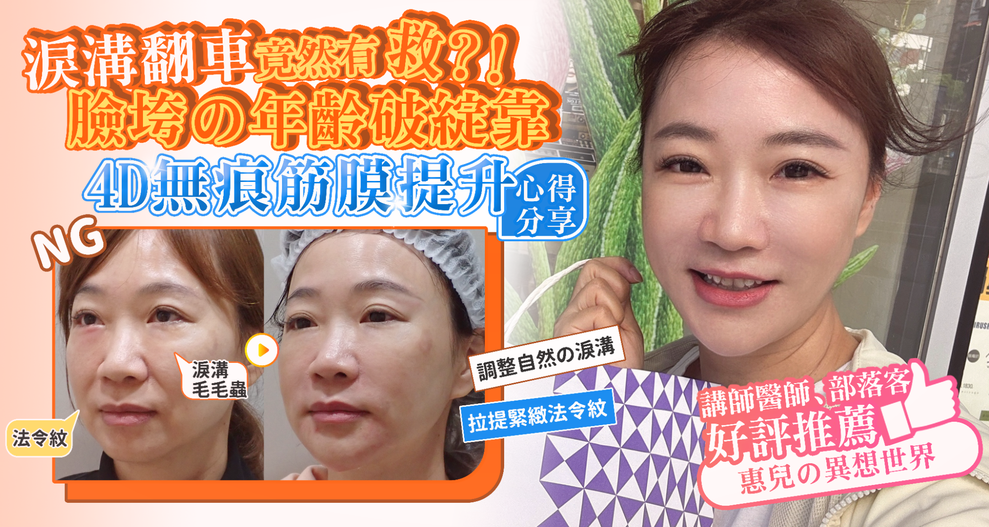 法令紋真的藏不住年紀?淚溝失敗竟然有得救?告別無盡的修圖深淵|神奇的 4D無痕筋膜提升 1 彥靚診所 4D無痕筋膜提升 黃政達醫師 拉提 緊緻 淚溝重修 眼袋 法令紋 玻尿酸 填補 幼態臉 複合式微整 鬆弛 下垂 嘴邊肉 雙下巴 輪廓線 下顎線 淚溝硬塊 分享 推薦 桃園 台北 新竹 1150060102