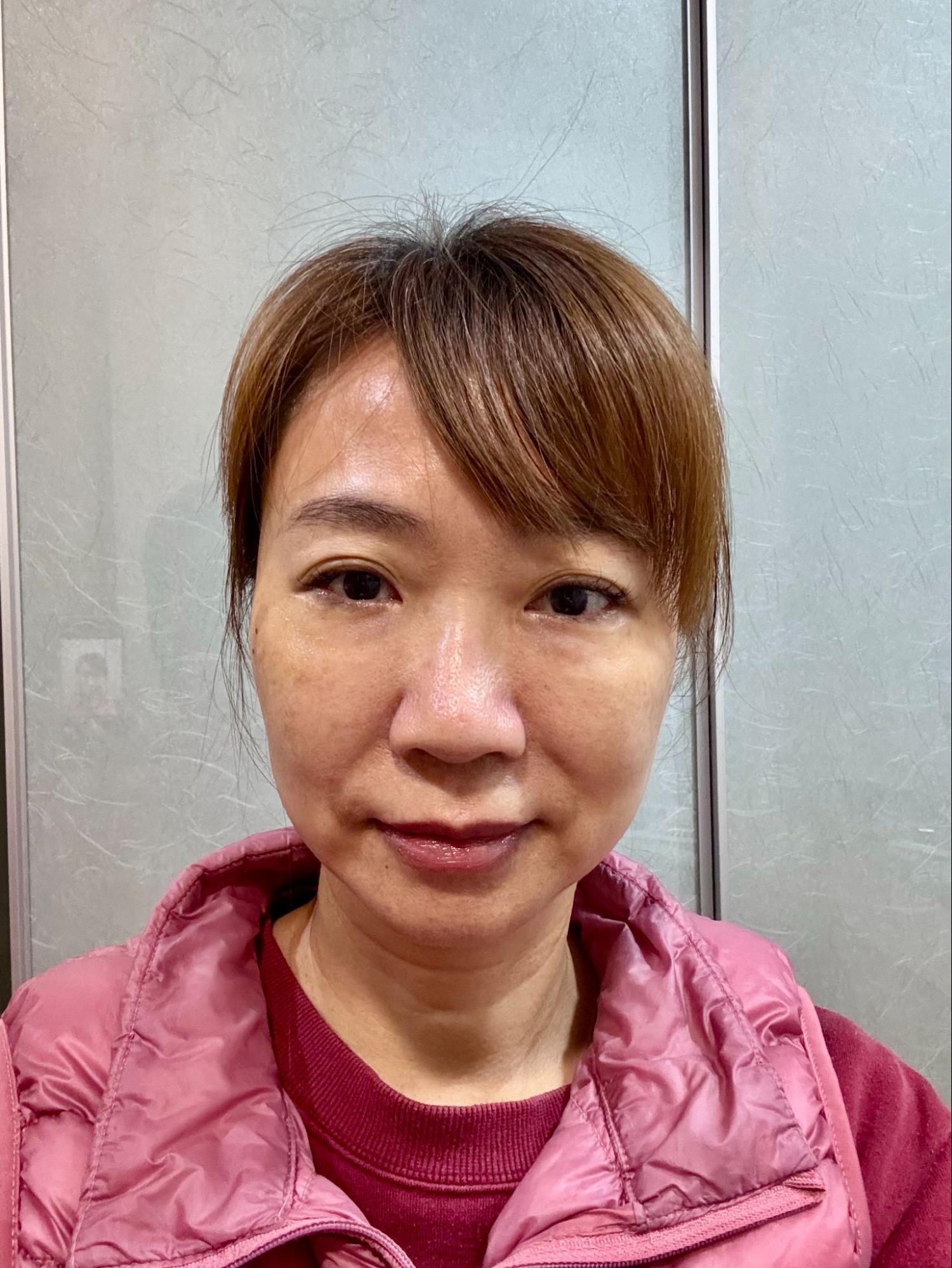 法令紋真的藏不住年紀?淚溝失敗竟然有得救?告別無盡的修圖深淵|神奇的 4D無痕筋膜提升 8 彥靚診所 4D無痕筋膜提升 黃政達醫師 拉提 緊緻 淚溝重修 眼袋 法令紋 玻尿酸 填補 幼態臉 複合式微整 鬆弛 下垂 嘴邊肉 雙下巴 輪廓線 下顎線 淚溝硬塊 分享 推薦 桃園 台北 新竹 1150060109