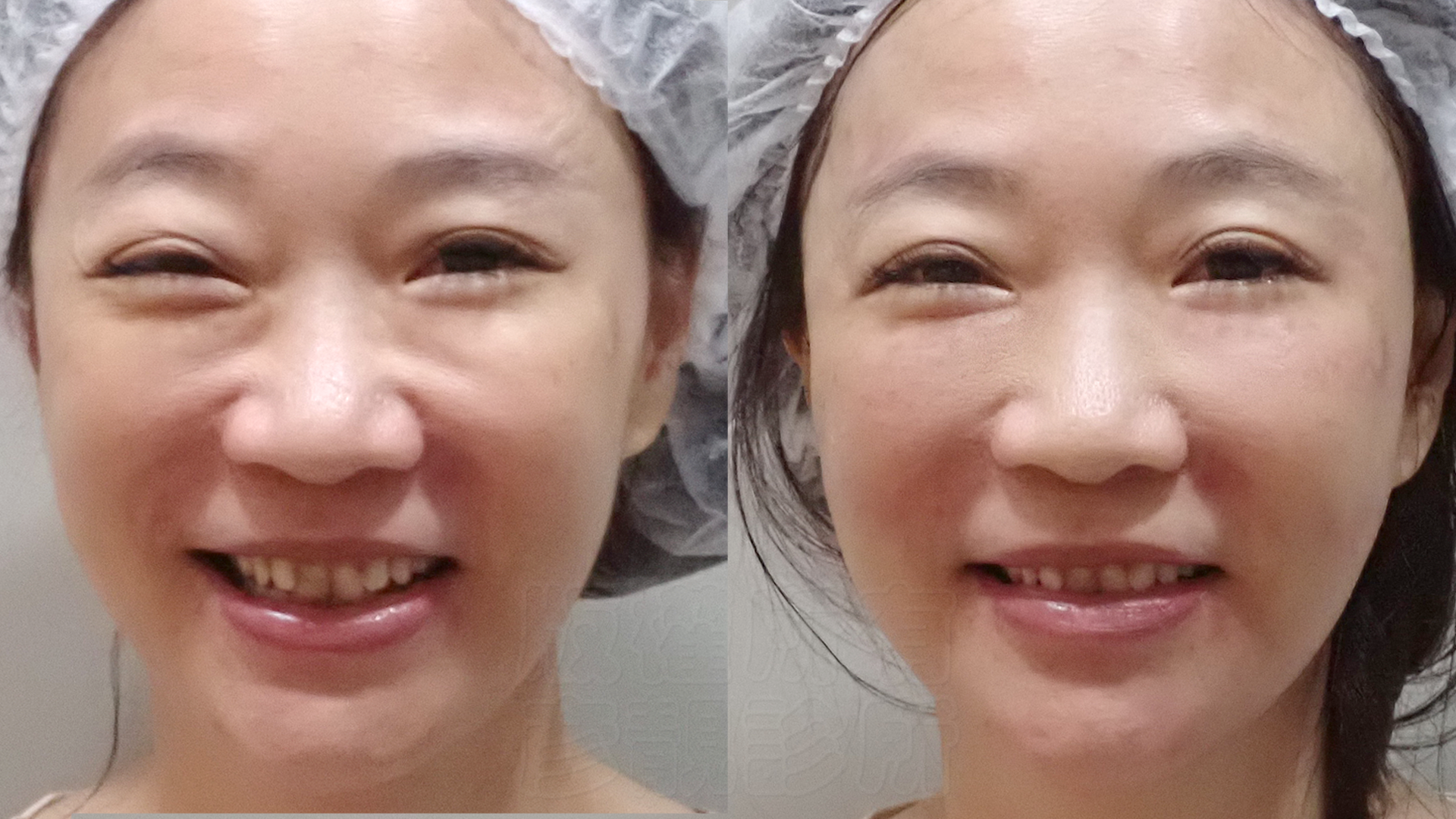 法令紋真的藏不住年紀?淚溝失敗竟然有得救?告別無盡的修圖深淵|神奇的 4D無痕筋膜提升 15 彥靚診所 4D無痕筋膜提升 黃政達醫師 拉提 緊緻 淚溝重修 眼袋 法令紋 玻尿酸 填補 幼態臉 複合式微整 鬆弛 下垂 嘴邊肉 雙下巴 輪廓線 下顎線 淚溝硬塊 分享 推薦 桃園 台北 新竹 1150060115