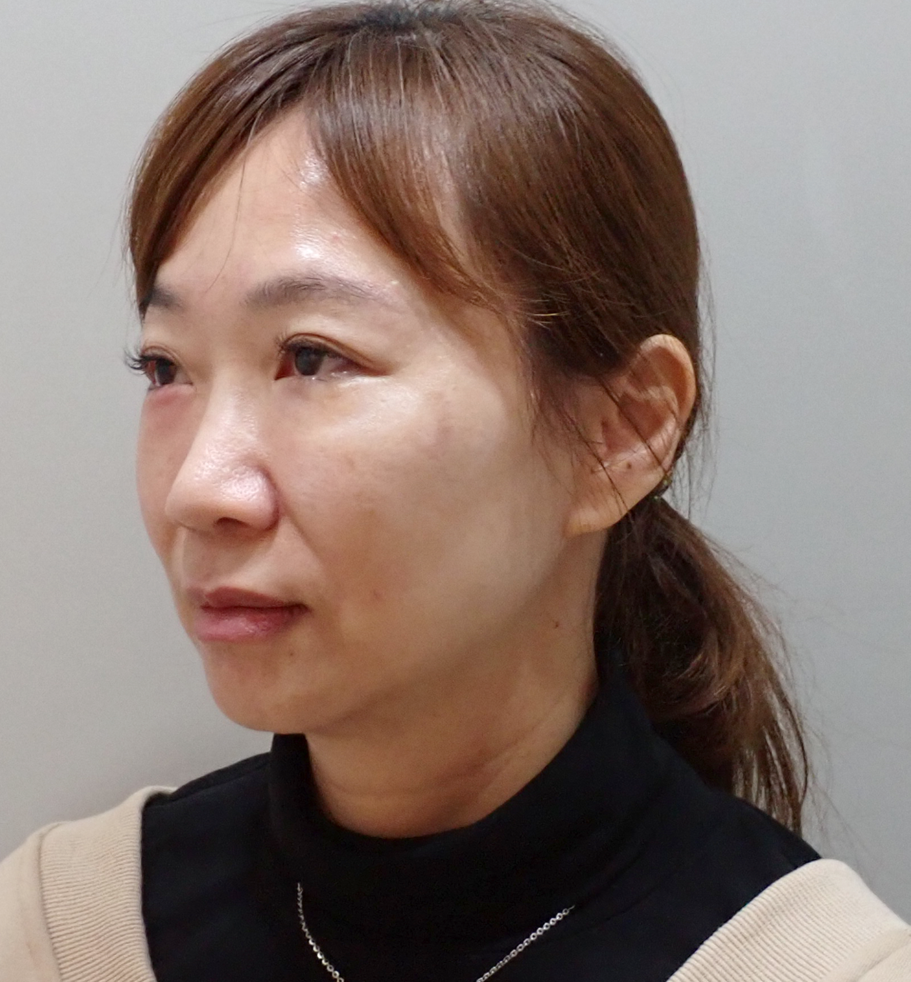 法令紋真的藏不住年紀?淚溝失敗竟然有得救?告別無盡的修圖深淵|神奇的 4D無痕筋膜提升 16 彥靚診所 4D無痕筋膜提升 黃政達醫師 拉提 緊緻 淚溝重修 眼袋 法令紋 玻尿酸 填補 幼態臉 複合式微整 鬆弛 下垂 嘴邊肉 雙下巴 輪廓線 下顎線 淚溝硬塊 分享 推薦 桃園 台北 新竹 1150060116