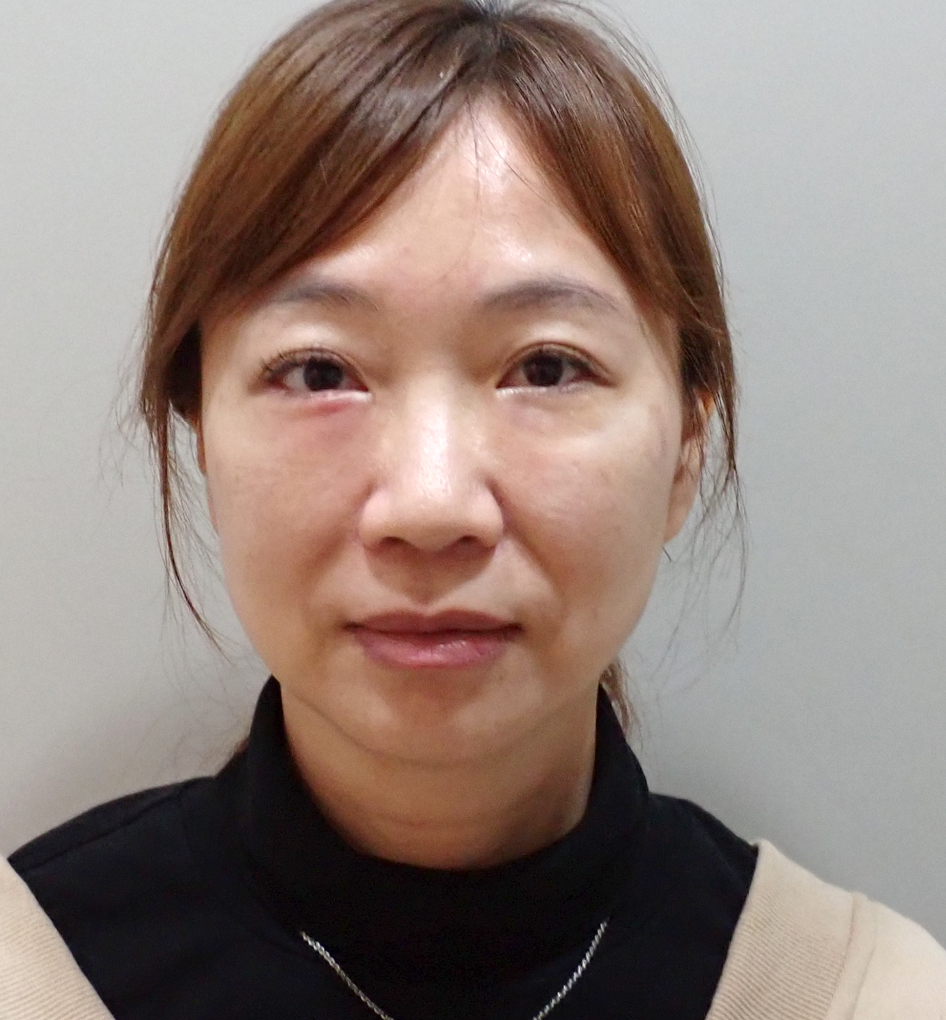 法令紋真的藏不住年紀?淚溝失敗竟然有得救?告別無盡的修圖深淵|神奇的 4D無痕筋膜提升 17 彥靚診所 4D無痕筋膜提升 黃政達醫師 拉提 緊緻 淚溝重修 眼袋 法令紋 玻尿酸 填補 幼態臉 複合式微整 鬆弛 下垂 嘴邊肉 雙下巴 輪廓線 下顎線 淚溝硬塊 分享 推薦 桃園 台北 新竹 1150060117