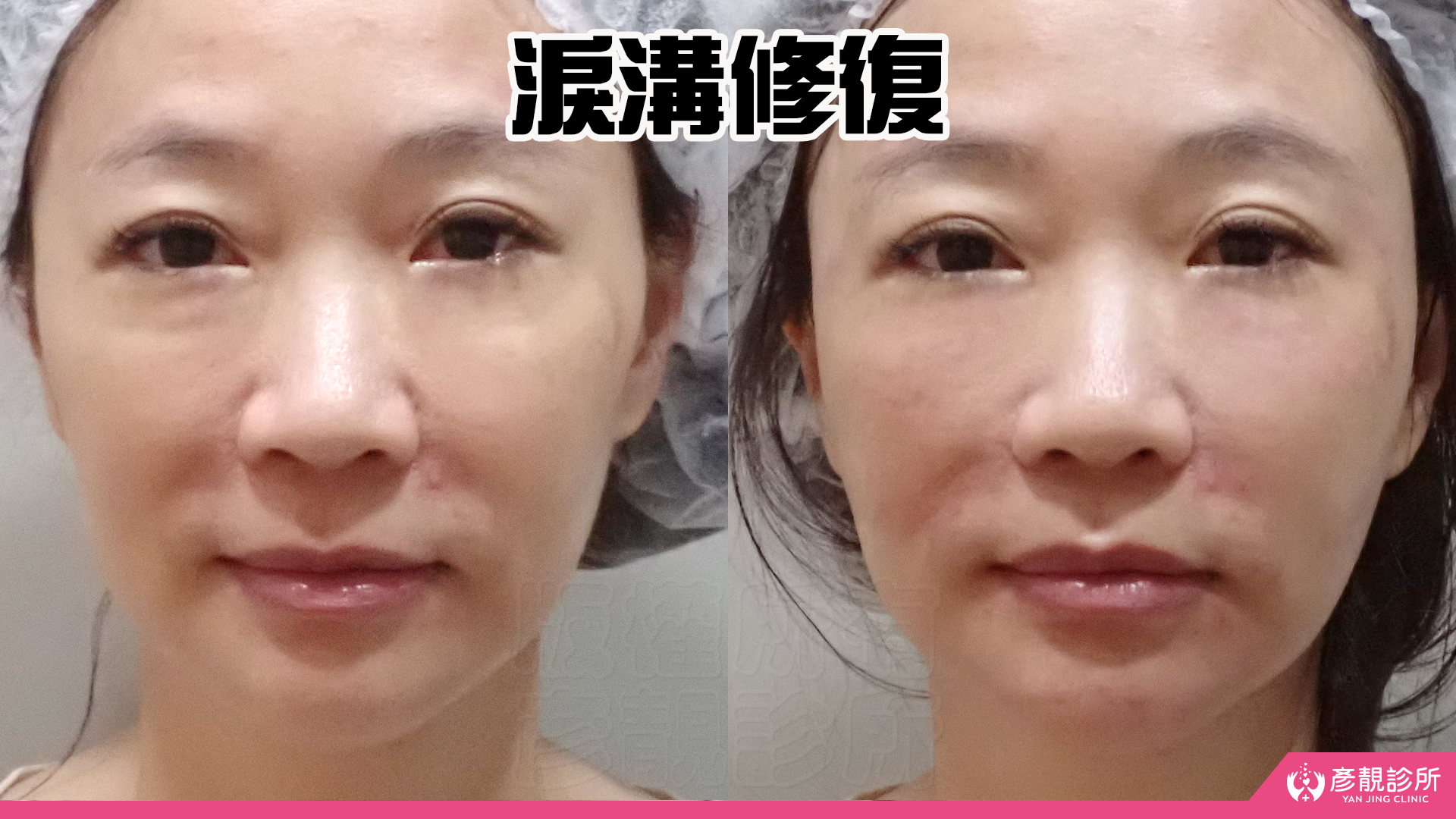 法令紋真的藏不住年紀?淚溝失敗竟然有得救?告別無盡的修圖深淵|神奇的 4D無痕筋膜提升 24 彥靚診所 4D無痕筋膜提升 黃政達醫師 拉提 緊緻 淚溝重修 眼袋 法令紋 玻尿酸 填補 幼態臉 複合式微整 鬆弛 下垂 嘴邊肉 雙下巴 輪廓線 下顎線 淚溝硬塊 分享 推薦 桃園 台北 新竹 1150060124