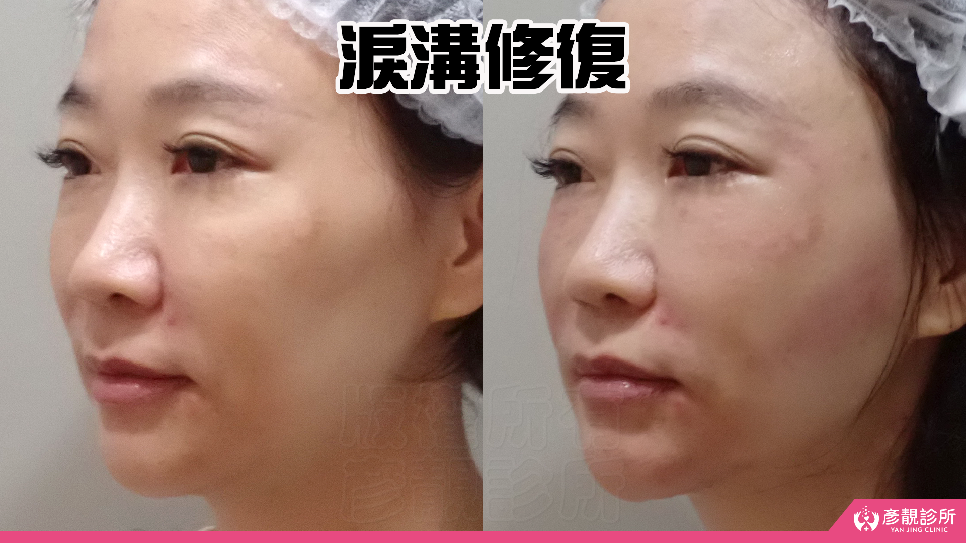 法令紋真的藏不住年紀?淚溝失敗竟然有得救?告別無盡的修圖深淵|神奇的 4D無痕筋膜提升 27 彥靚診所 4D無痕筋膜提升 黃政達醫師 拉提 緊緻 淚溝重修 眼袋 法令紋 玻尿酸 填補 幼態臉 複合式微整 鬆弛 下垂 嘴邊肉 雙下巴 輪廓線 下顎線 淚溝硬塊 分享 推薦 桃園 台北 新竹 1150060125