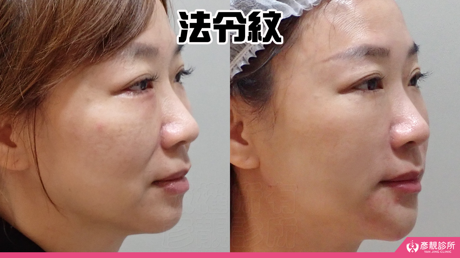 法令紋真的藏不住年紀?淚溝失敗竟然有得救?告別無盡的修圖深淵|神奇的 4D無痕筋膜提升 31 彥靚診所 4D無痕筋膜提升 黃政達醫師 拉提 緊緻 淚溝重修 眼袋 法令紋 玻尿酸 填補 幼態臉 複合式微整 鬆弛 下垂 嘴邊肉 雙下巴 輪廓線 下顎線 淚溝硬塊 分享 推薦 桃園 台北 新竹 1150060134