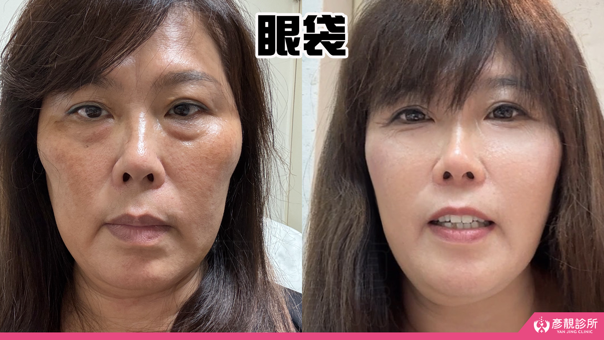 淚溝眼袋療程推薦 彥靚診所 黃政達醫師 不動刀就能告別疲憊感,自然感才是王道! 17 玻尿酸 淚溝 眼袋 肉毒 除皺 皺紋 抬頭紋 皺眉 木偶紋 法令紋 黑眼圈 熊貓針 墊下巴 下顎線 筋膜拉提 下垂 拉提 效果 費用 價格 彥靚診所 醫美 門診 醫生 桃園 台北 新竹 Dcard ppt 115062218
