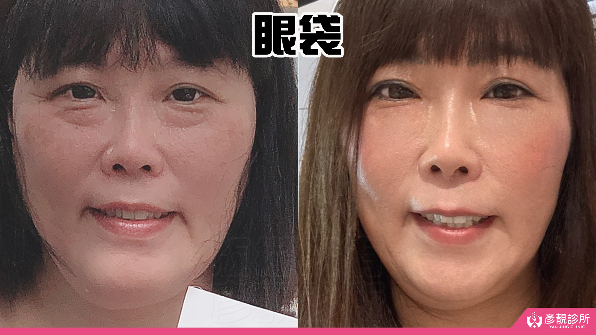 淚溝眼袋療程推薦 彥靚診所 黃政達醫師 不動刀就能告別疲憊感,自然感才是王道! 19 玻尿酸 淚溝 眼袋 肉毒 除皺 皺紋 抬頭紋 皺眉 木偶紋 法令紋 黑眼圈 熊貓針 墊下巴 下顎線 筋膜拉提 下垂 拉提 效果 費用 價格 彥靚診所 醫美 門診 醫生 桃園 台北 新竹 Dcard ppt 115062219