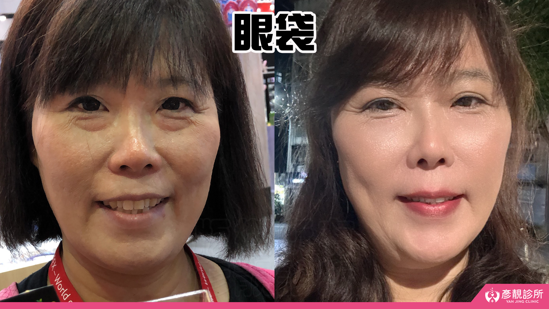 淚溝眼袋療程推薦 彥靚診所 黃政達醫師 不動刀就能告別疲憊感,自然感才是王道! 18 玻尿酸 淚溝 眼袋 肉毒 除皺 皺紋 抬頭紋 皺眉 木偶紋 法令紋 黑眼圈 熊貓針 墊下巴 下顎線 筋膜拉提 下垂 拉提 效果 費用 價格 彥靚診所 醫美 門診 醫生 桃園 台北 新竹 Dcard ppt 115062220