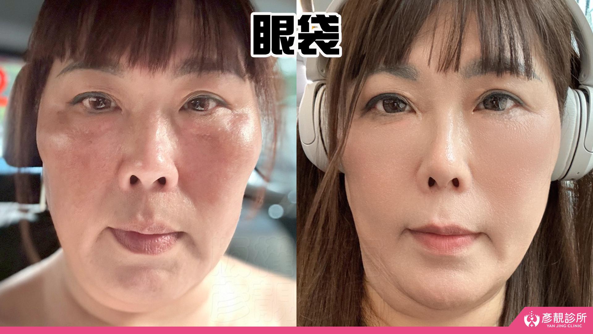 淚溝眼袋療程推薦 彥靚診所 黃政達醫師 不動刀就能告別疲憊感,自然感才是王道! 20 玻尿酸 淚溝 眼袋 肉毒 除皺 皺紋 抬頭紋 皺眉 木偶紋 法令紋 黑眼圈 熊貓針 墊下巴 下顎線 筋膜拉提 下垂 拉提 效果 費用 價格 彥靚診所 醫美 門診 醫生 桃園 台北 新竹 Dcard ppt 115062221