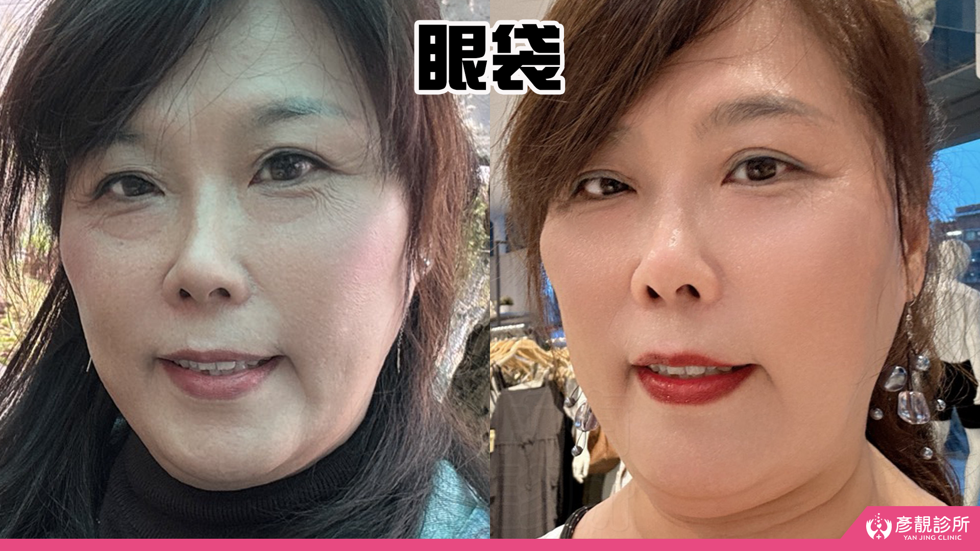 淚溝眼袋療程推薦 彥靚診所 黃政達醫師 不動刀就能告別疲憊感,自然感才是王道! 21 玻尿酸 淚溝 眼袋 肉毒 除皺 皺紋 抬頭紋 皺眉 木偶紋 法令紋 黑眼圈 熊貓針 墊下巴 下顎線 筋膜拉提 下垂 拉提 效果 費用 價格 彥靚診所 醫美 門診 醫生 桃園 台北 新竹 Dcard ppt 115062222
