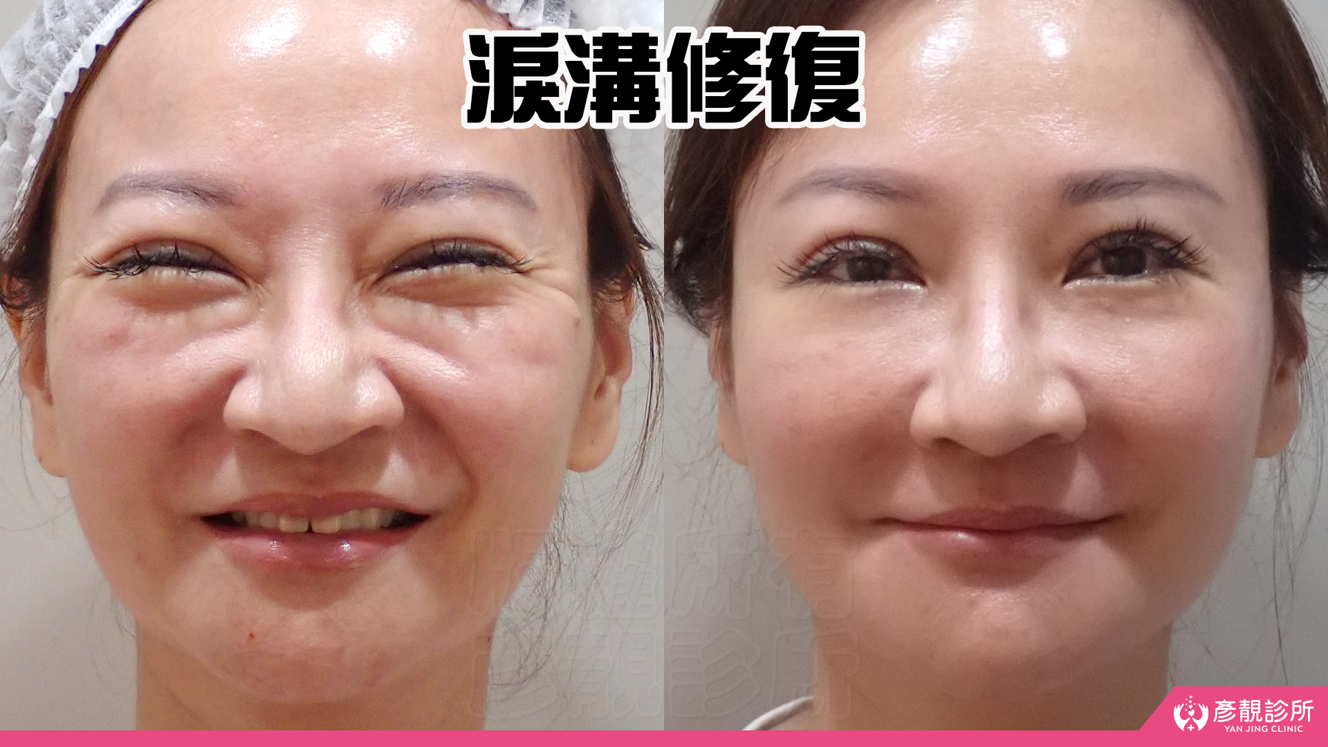 告別顯老頸紋與雞爪手!大分子玻尿酸打造高級天鵝頸與貴婦澎潤感 18 雞爪手 不動刀改善 脖紋 頸部拉提 玻尿酸 彥靚 診所 膠原蛋白 推薦 撫紋填補 價格費用 台北 桃園 新竹 頸紋 評價 黃政達 醫師 結節 凹凸不平 副作用 併發症 後遺症 心得 分享 硬塊 115061919