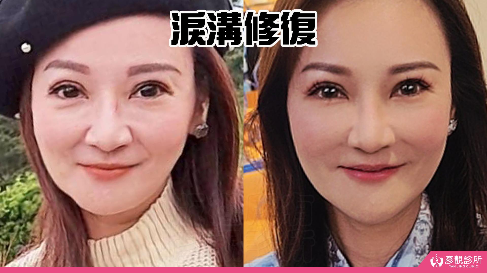 告別顯老頸紋與雞爪手!大分子玻尿酸打造高級天鵝頸與貴婦澎潤感 29 雞爪手 不動刀改善 脖紋 頸部拉提 玻尿酸 彥靚 診所 膠原蛋白 推薦 撫紋填補 價格費用 台北 桃園 新竹 頸紋 評價 黃政達 醫師 結節 凹凸不平 副作用 併發症 後遺症 心得 分享 硬塊 115061924