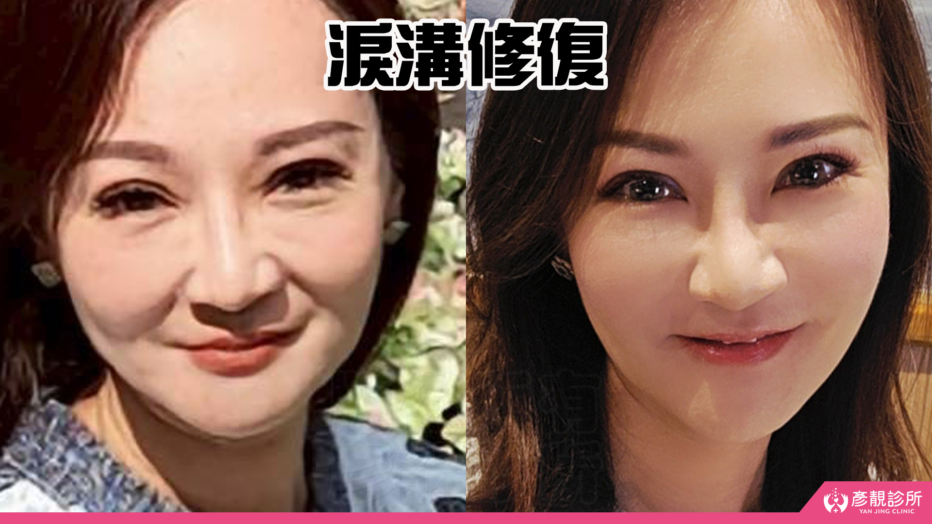 告別顯老頸紋與雞爪手!大分子玻尿酸打造高級天鵝頸與貴婦澎潤感 28 雞爪手 不動刀改善 脖紋 頸部拉提 玻尿酸 彥靚 診所 膠原蛋白 推薦 撫紋填補 價格費用 台北 桃園 新竹 頸紋 評價 黃政達 醫師 結節 凹凸不平 副作用 併發症 後遺症 心得 分享 硬塊 115061925